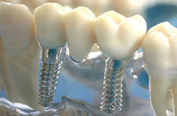 Имплантация зубов Киев, имплантация зубов цены, имплантация зубов стоимость, отзывы.