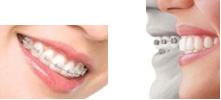 Прием у ортодонта, консультация, стоимость ортодонтического лечения.