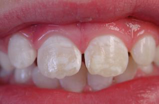 Белые пятна на зубах, удаление зуба, белые пятна на зубах у ребенка